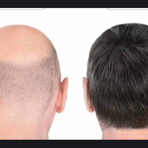 photo of Mens Toupees for Cancer Patients- build confidence each day at 1177 Goldfinch Lane Anne Arundel County MD 21108