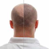 Hair transplantation