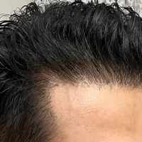 Hair Transplant